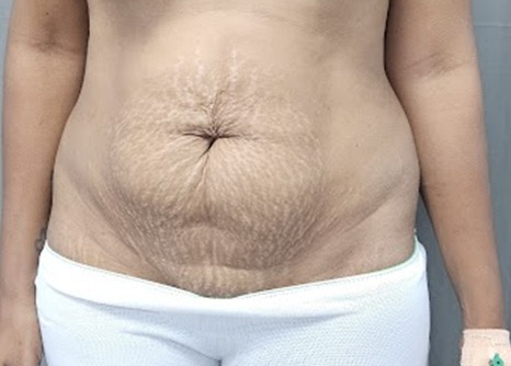 Tummy Tuck Before