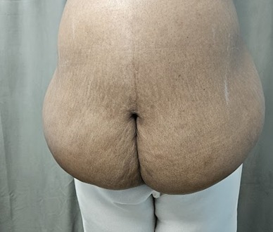 Body Contouring